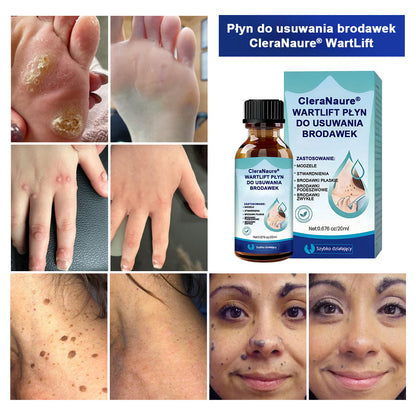 CleraNaure® WartLift Płyn do usuwania odcisków