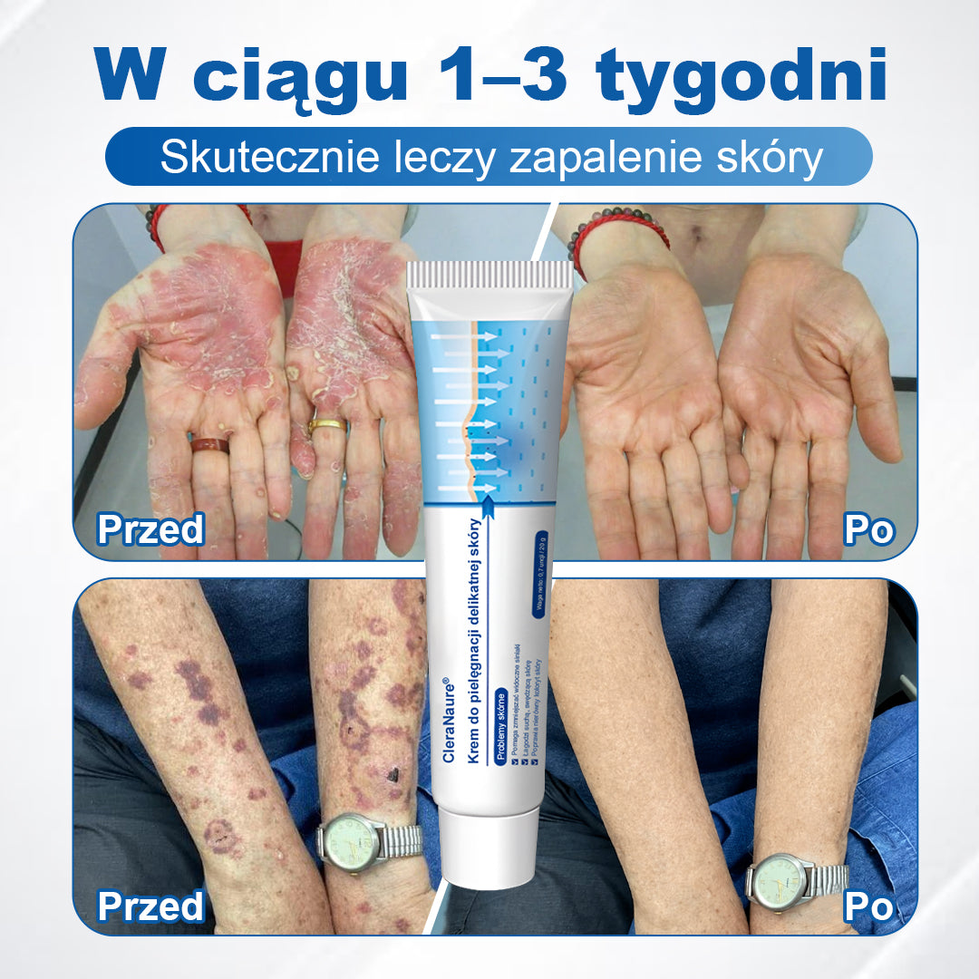 CleraNaure® Krem Naprawczy do Skóry Delikatnej 🌿 Wielotorowa Naprawa – na Siniaki, Suchość i Przebarwienia