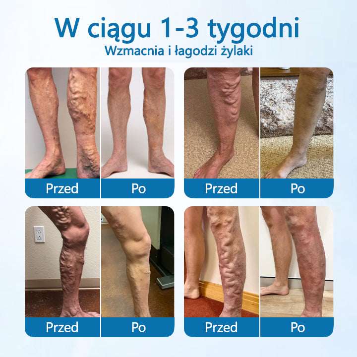 🪶CleraNaure® VeinGuard Ziołowy Spray – ✅ Klinicznie potwierdzone usuwanie żylaków w zaledwie 7 dni!
