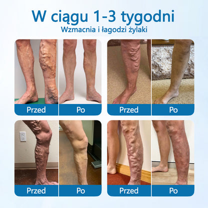 🪶CleraNaure® VeinGuard Ziołowy Spray – ✅ Klinicznie potwierdzone usuwanie żylaków w zaledwie 7 dni!