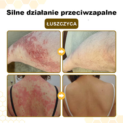 CleraNaure® PsoriaSoothe – Krem z jadem pszczelim przywracający zdrowie skórze