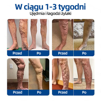 🥇Healrize® VeinTarget Plaster z mikroigłami✨