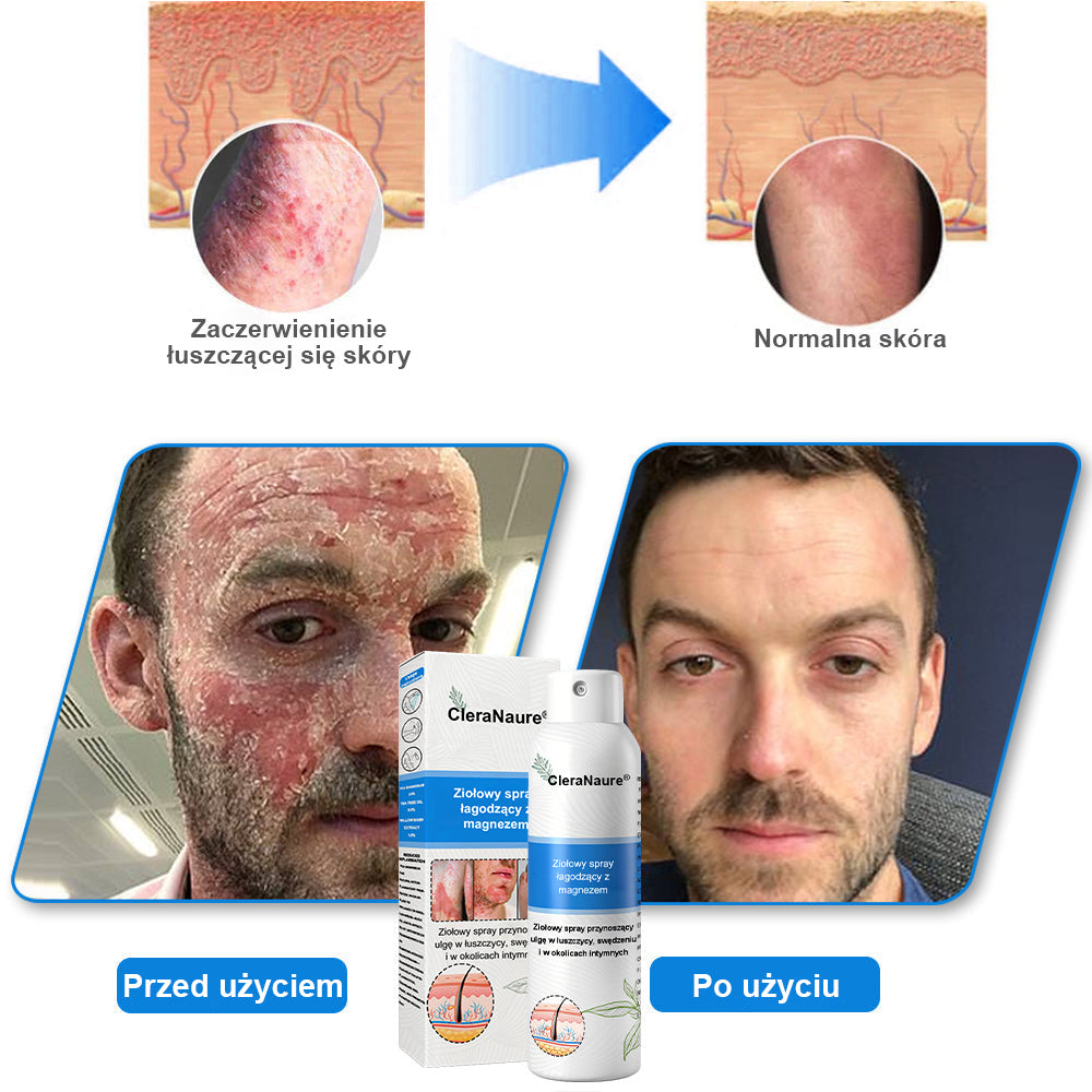 CleraNature® Magnesium Spray – Szybka Ulga dla Swędzącej, Czerwonej i Wrażliwej Skóry (Nawet w Strefach Intymnych)