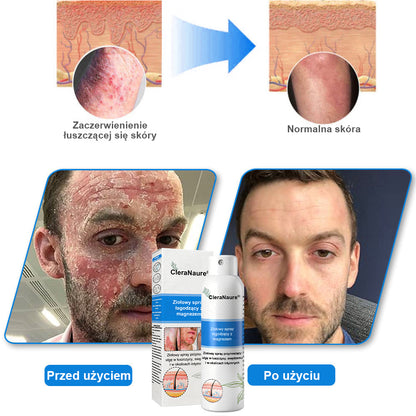 CleraNature® Magnesium Spray – Szybka Ulga dla Swędzącej, Czerwonej i Wrażliwej Skóry (Nawet w Strefach Intymnych)
